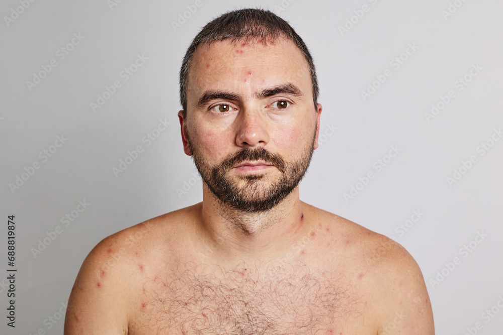 Man with acne, red spots, skin disease. Varicella or Herpes Zoster concept Man with acne, red spots, skin disease. Varicella or Herpes Zoster concept