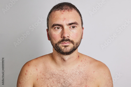 Man with acne, red spots, skin disease. Varicella or Herpes Zoster concept photo