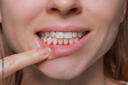 Woman showing inflamed gum  closeup. Oral cavity health