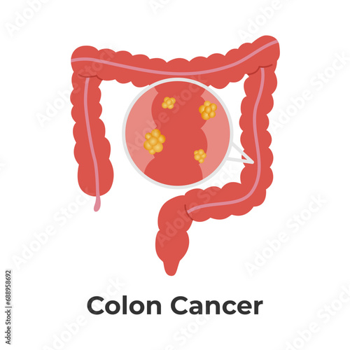 Colon Cancer Vector Illustration for Education