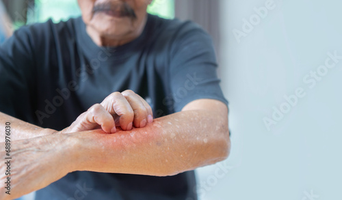 Cropped image of Asian elder man scratching his forearm. Concept of itchy skin diseases such as scabies, fungal infection. photo