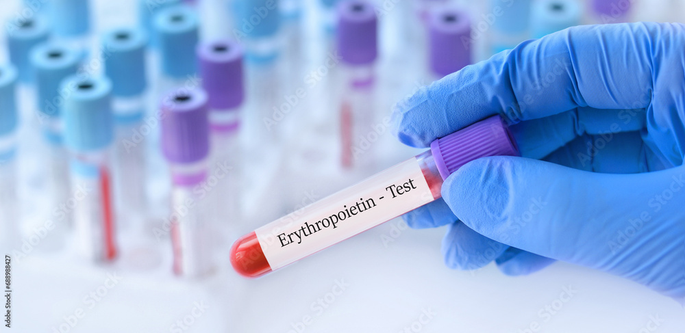 Doctor holding a test blood sample tube with erythropoietin test on the background of medical test tubes with analyzes Doctor holding a test blood sample tube with erythropoietin test on the background of medical test tubes with analyzes