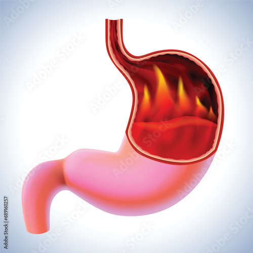 3D illustration of a stomach with flames burning inside is a sign of burning pain, a symptom of gastritis. cut open to see inside For medical, educational, industrial and scientific use
