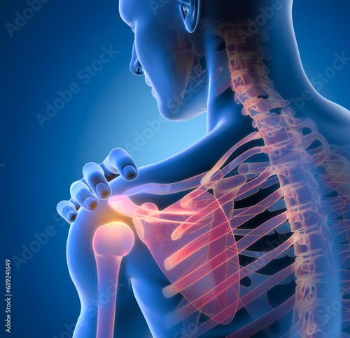 Painful shoulder joints. Frozen shoulder, Impingement. 3D illustration photo