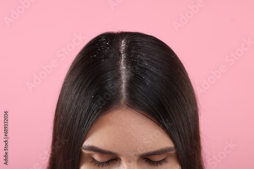 Woman with dandruff in her dark hair on pink background, closeup