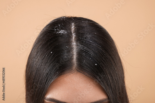Woman with dandruff in her dark hair on beige background, closeup