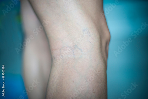 Varicose veins on the body's skin