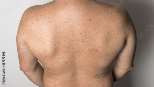 Naked man with red pimples on his back, acne skin disease, dermatology problem