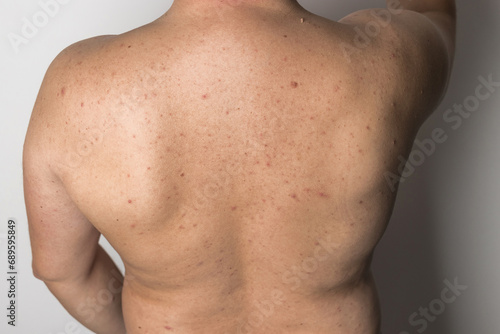 Naked man with red pimples on his back, acne skin disease, dermatology problem