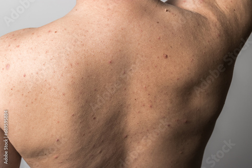 Naked man with red pimples on his back, acne skin disease, dermatology problem