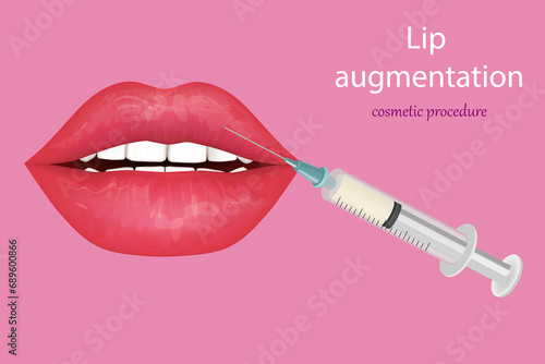 Procedure lip augmentation. Cosmetic procedure that modifies the shape of the lips using fillers. Beauty Injection For Lips. Collagen or implants.