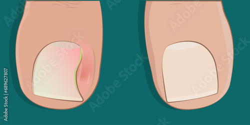 Ingrown toenail on the big toe. Before and after. Inflammatory purulent process.