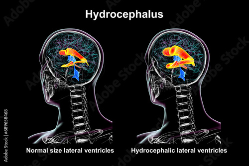Enlarged and normal lateral ventricles, 3D illustration