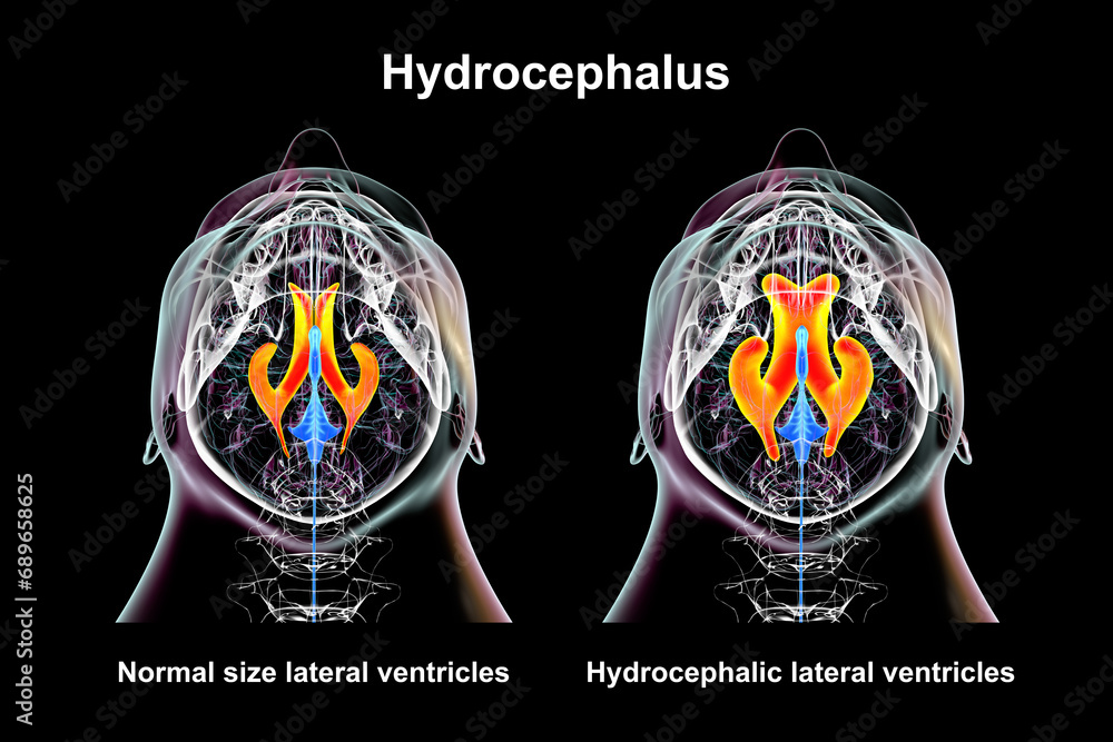 Enlarged and normal lateral ventricles, 3D illustration - obrazy, fototapety, plakaty 