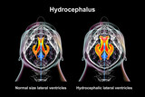 Enlarged and normal lateral ventricles, 3D illustration