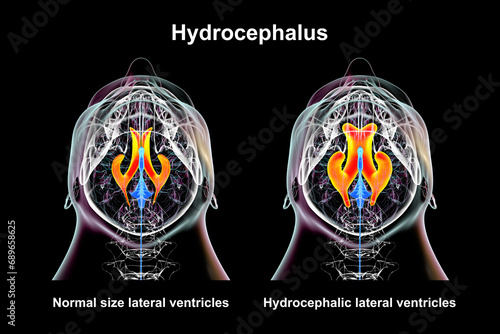 Enlarged and normal lateral ventricles, 3D illustration photo
