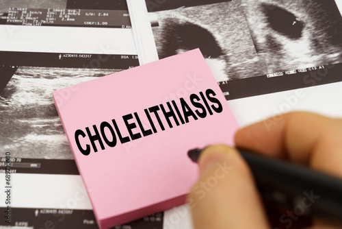 On the ultrasound pictures there are stickers that say - Cholelithiasis photo
