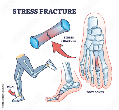 Stress fracture explanation with skeletal foot bone injury outline diagram. Labeled educational scheme with phalanges tear after physical running activities and overuse in walking vector illustration