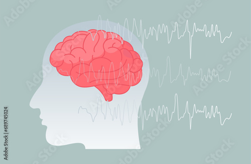 Epilepsy - A Neurological Condition - Stock Illustration