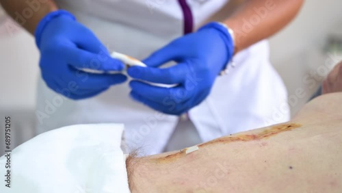 Close up of nurse's hand cleans and treats abdomen injury after surgery at the hospital. Surgical wound on the abdomen. High quality 4k footage photo