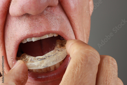 Older Mature Man putting in a night Guard in his mouth to prevent grinding