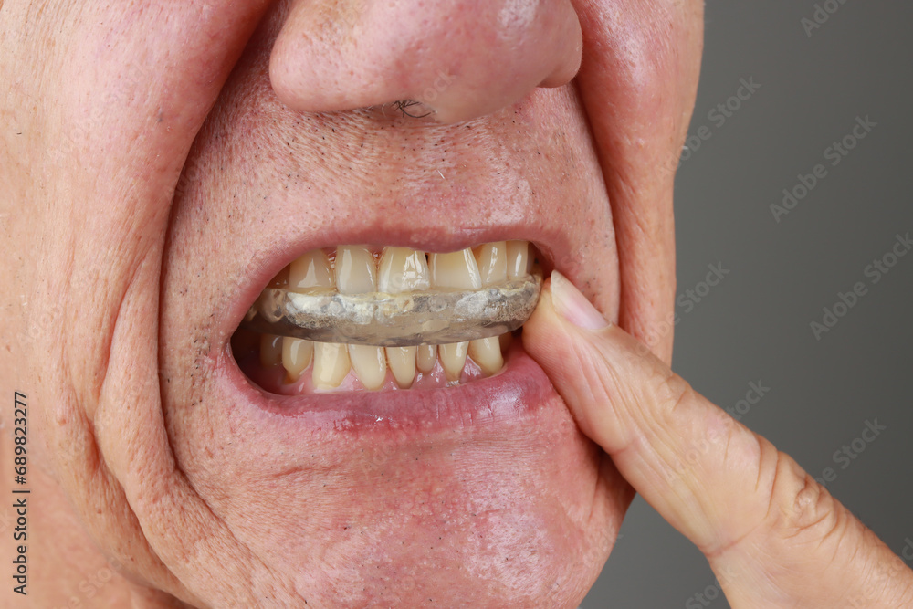 Older Mature Man putting in a night Guard in his mouth to prevent grinding