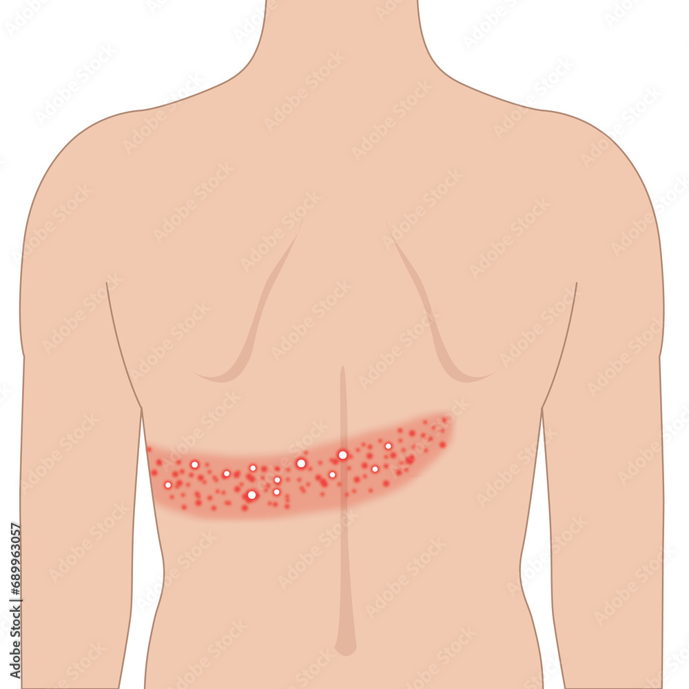 Ahingles Rash Back Red shingles rash allergy on the back skin body, illustration on white ...