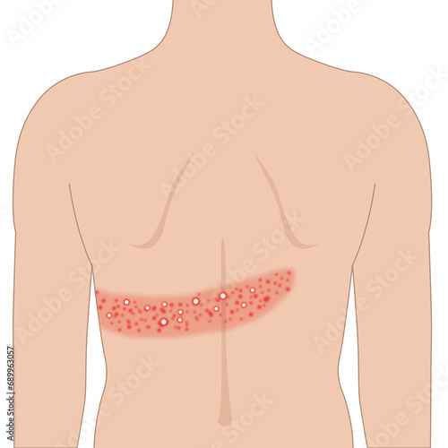 Red shingles rash allergy on the back skin  body, illustration on white background