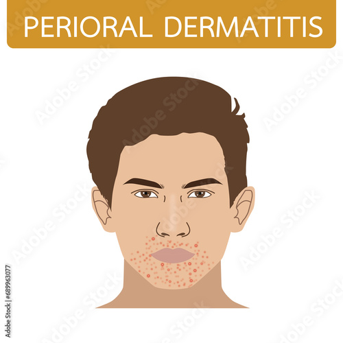 Perioral dermatitis on man's face allergy around mouth, illustration on white background photo