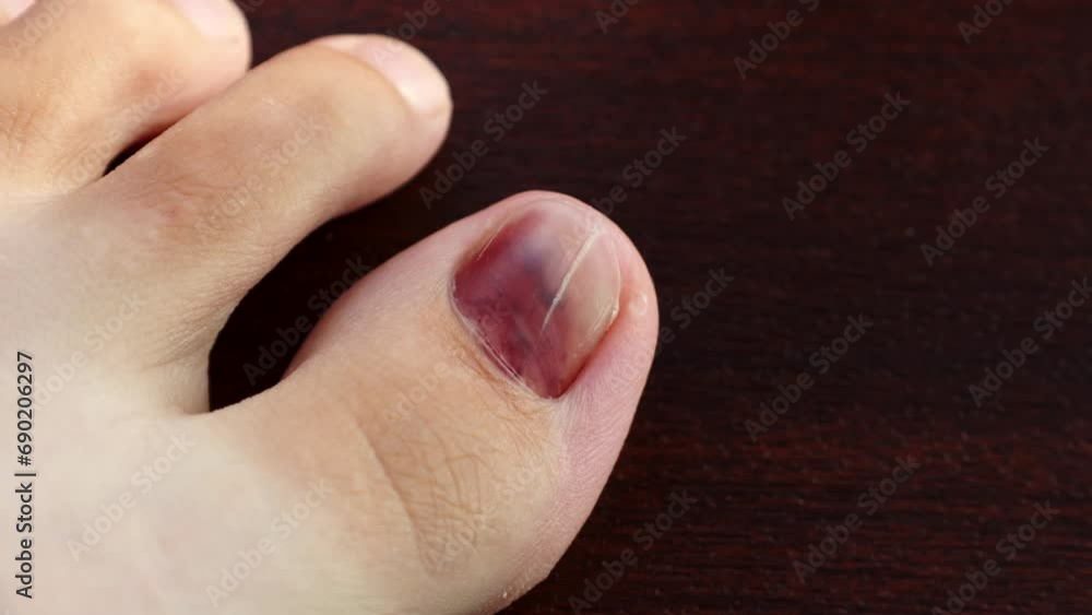 Runner's toe or subungual hematoma after toenail trauma. Bruise under ...