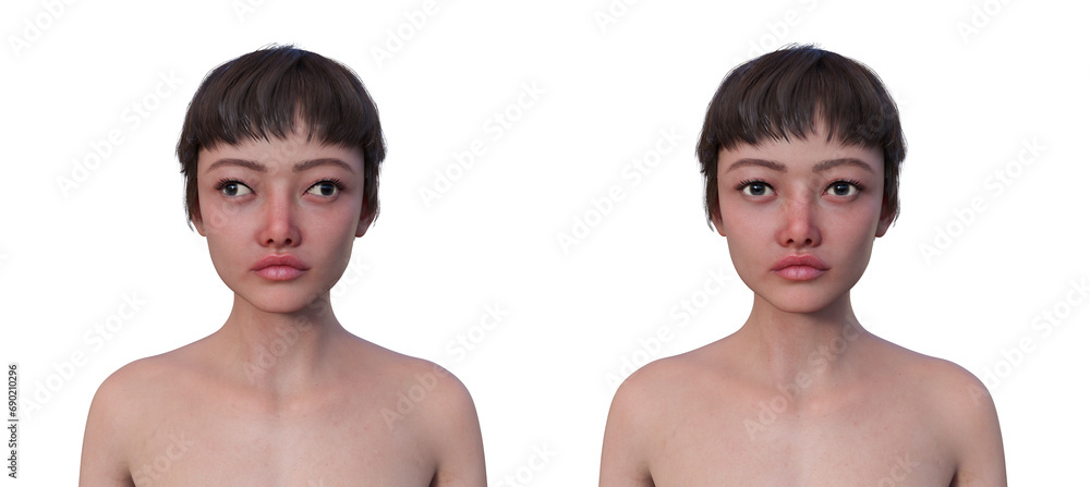 A woman with exotropia and a healthy person, 3D illustration A woman with exotropia and a healthy person, 3D illustration