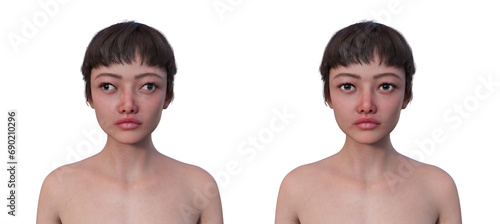 A woman with exotropia and a healthy person, 3D illustration photo