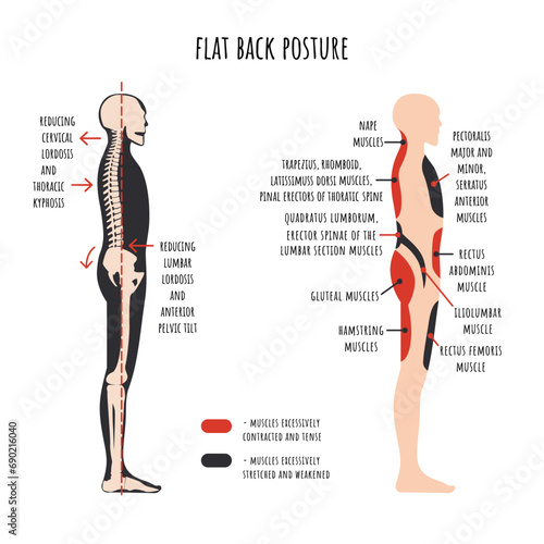 Posture disorders infographics. Flat back posture. The side view shows characteristic decrease natural curves of spine, pelvis rotation, stretched and weakened, shortened and tens muscles. Vector.