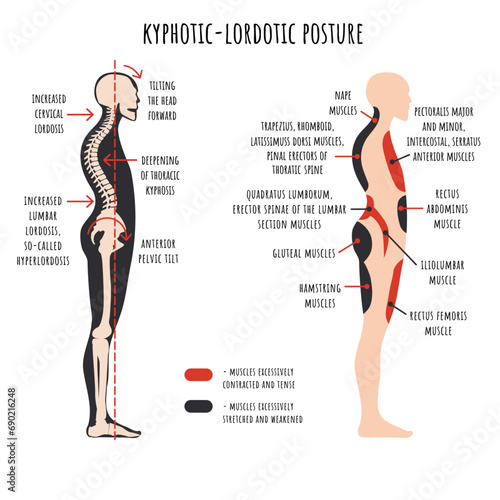 Posture disorders infographic. Kyphotic lordotic posture. The side view shows deformation of rounded shoulders and hyperlordosis, pelvis rotation, stretched and weakened, shortened and tens muscles.