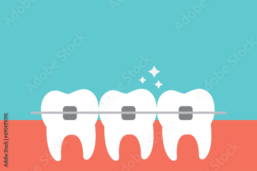 White teeth with dental braces vector flat illustration. Alignment of bite of teeth. Dental clinic service, cosmetic odontology, teeth straightening, and orthodontic procedures concept.