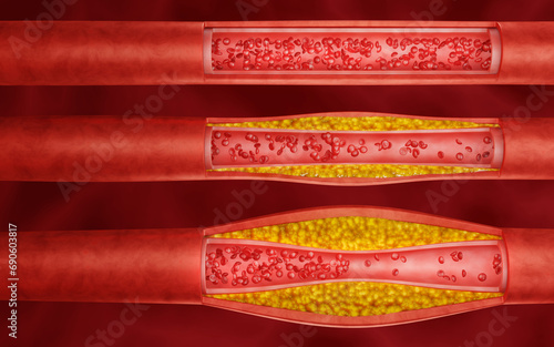 Set of Hyperlipidemia or arteriosclerosis. Blocked artery concept and human blood vessel as a disease with cholesterol fat buildup clogging. Clogged arteries, Cholesterol plaque in the artery photo