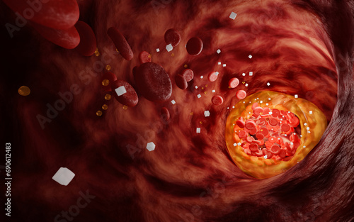 Hyperlipidemia or arteriosclerosis. Blocked artery concept and human blood vessel as a disease with cholesterol fat buildup clogging. Clogged arteries, Cholesterol plaque in the artery. 3D Rendering photo