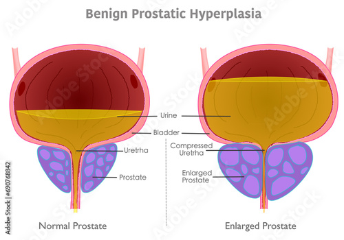 Benign prostatic hyperplasia anatomy. Enlarged, normal prostate, cancer, BPH. Compressed bladder glans, urinate pee flow. Medical illustration vector