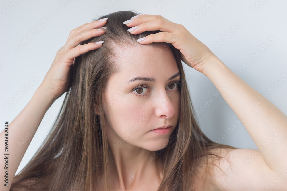 young pretty brunette woman suffering from hair loss spreads her hair in the temple area with both hands. Woman's health. Baldness, the effects of the disease, lack of vitamins. young pretty brunette woman suffering from hair loss spreads her hair in the temple area with both hands. Woman's health. Baldness, the effects of the disease, lack of vitamins.