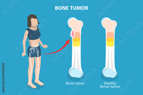 3D Isometric Flat Vector Illustration of Bone Tumor, Orthopedic Problem