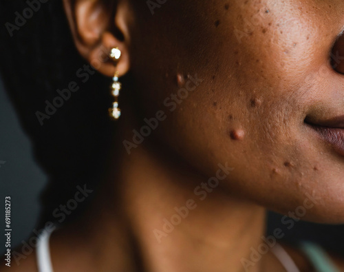 macro details of a pimples and blemishes
