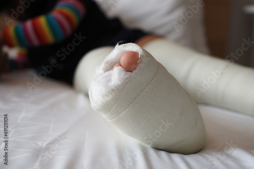 little child with plaster bandage on leg. photo