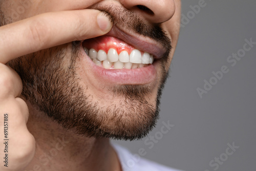 Man showing inflamed gum on grey background, closeup. Space for text