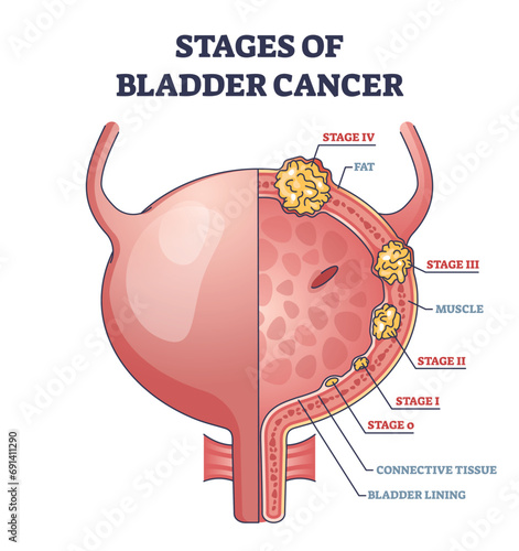 Stages of bladder cancer with anatomical oncology model outline diagram. Labeled educational scheme with illness growth and medical condition development vector illustration. Pathology diagnosis.