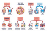 Septic arthritis as joint infection and infection in bone outline diagram. Labeled educational scheme with symptoms, transmission, risk factors and treatment vector illustration. Medical disease.
