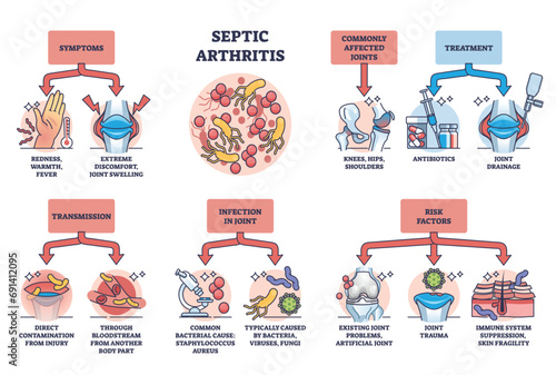 Septic arthritis as joint infection and infection in bone outline diagram. Labeled educational scheme with symptoms, transmission, risk factors and treatment vector illustration. Medical disease.
