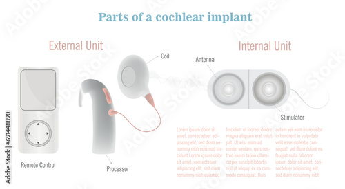 Parts of a cochlear implant from the remote control, the external part that is placed in the ear and then the internal part that is implanted in the head.