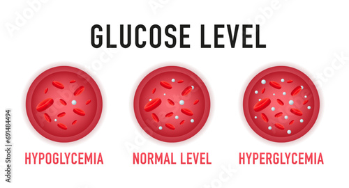 Hyperglycemia, High Blood Sugar and Diabetes ,obesity is a serious medical condition causes, vector design. Glucose blood level sugar test. Vector illustration