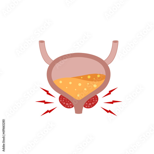 Inflammation of prostate. Yellow urine. Concept of prostatitis. Flat cartoon. Scheme of health and bladder problems isolated on white background