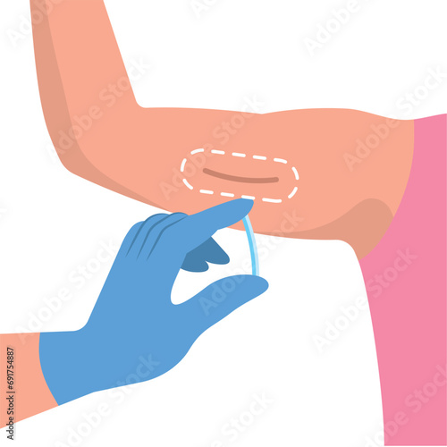 contraceptive implant birth control